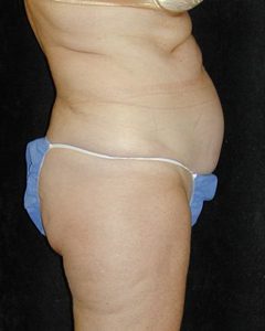 Case--7885 | Before Tummy Tuck 1