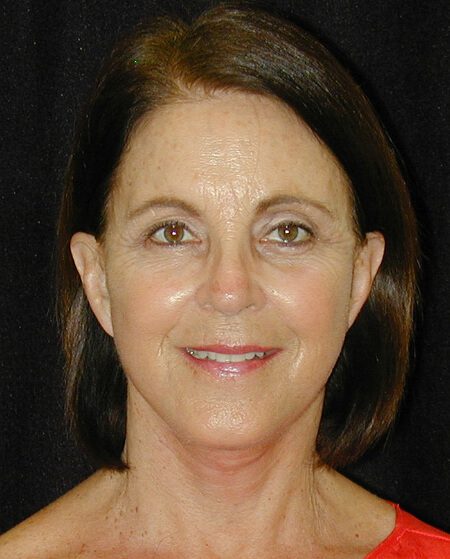 Case--1698 | After Face Lift and Neck Lift 1