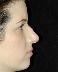 Case--7305 | Before Nose Surgery 1