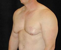 Case--8968 | Before Male Breast Reduction 1