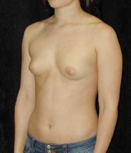 Case--9163 | Before Breast Augmentation 1