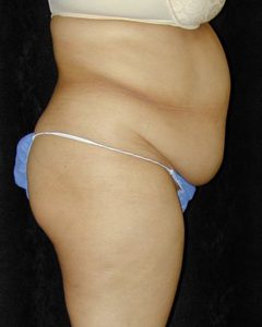 Case--4080 | Before Tummy Tuck 1