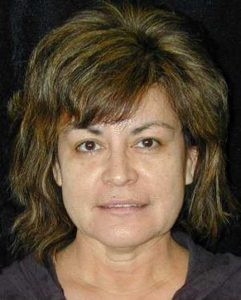 Case--3313 | Before Face Lift and Neck Lift 1