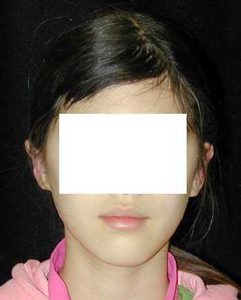 Case--1234 | After Ear Surgery 1