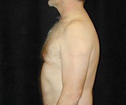 Male-Breast-Reduction-Case--1919 | After Male Breast Reduction 1