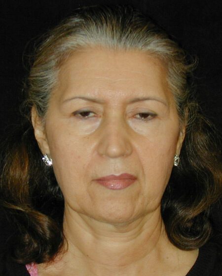 Case--9197 | Before Face Lift and Neck Lift 1