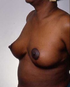 Case--1621 | After Breast Reduction 1