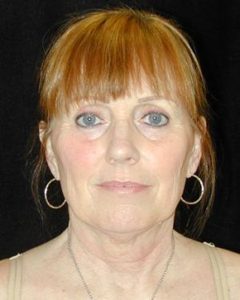 Case--6249 | Before Face Lift and Neck Lift 1