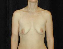 Case--8508 | Before Breast Lift 1