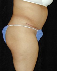 Case--4080 | After Tummy Tuck 1