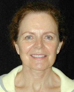 Case--3194 | After Face Lift and Neck Lift 1