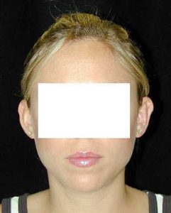 Case--6618 | After Ear Surgery 1