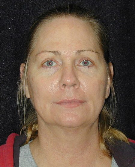 Case--4315 | Before Face Lift and Neck Lift 1