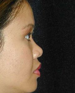 Case--8670 | Before Nose Surgery 1