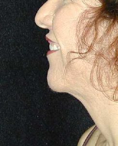 Case--4705 | After Chin Surgery 1