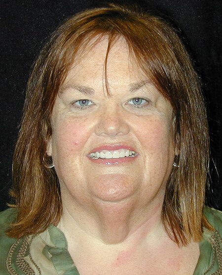 Case--9878 | Before Face Lift and Neck Lift 1