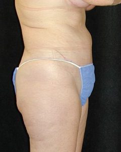 Case--7885 | After Tummy Tuck 1
