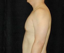 Case--8590 | After Male Breast Reduction 1