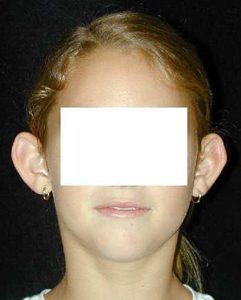 Case--7690 | Before Ear Surgery 1