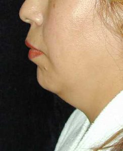 Case--6294 | Before Chin Surgery 1