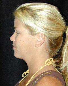 Case--7949 | After Liposuction 1