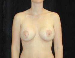 Case--8508 | After Breast Lift 1