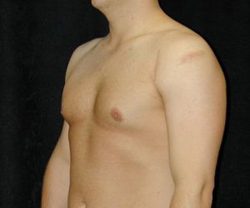 Case--5801 | After Male Breast Reduction 1