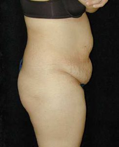 Case--9109 | Before Tummy Tuck 1