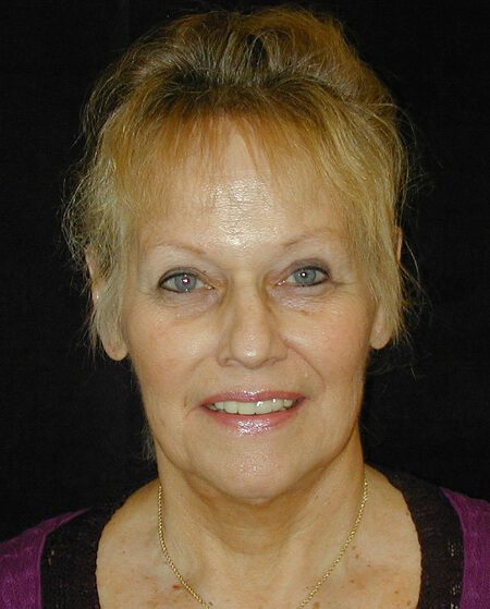 Case--5921 | Before Face Lift and Neck Lift 1