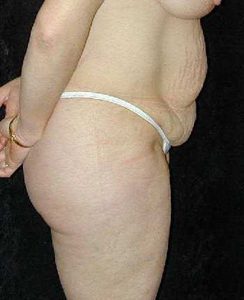 Case--7014 | Before Tummy Tuck 1