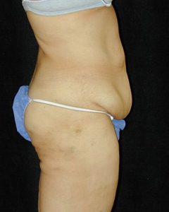 Case--2662 | Before Tummy Tuck 1