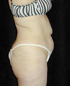 Case--9530 | Before Tummy Tuck 1