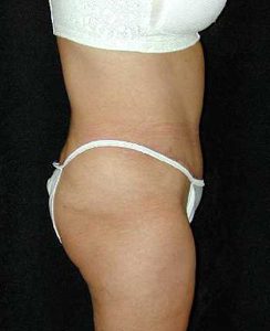 Case--7449 | After Tummy Tuck 1