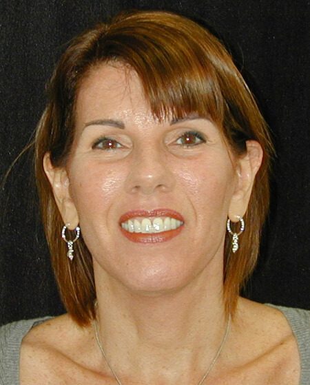 Case--5524 | After Face Lift and Neck Lift 1