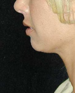 Case--6851 | Before Chin Surgery 1