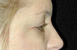 Case--4008 | Before Eyelid Surgery 1