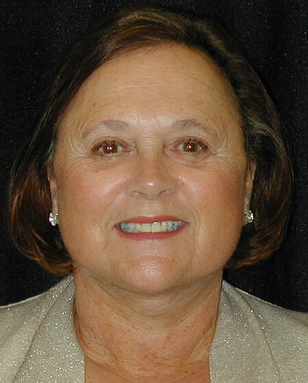 Case--6916 | After Face Lift and Neck Lift 1