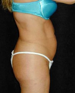 Case--4669 | Before Tummy Tuck 1