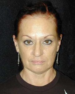 Case--6930 | Before Face Lift and Neck Lift 1