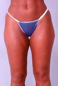 Case--6673 | Before Liposuction 1