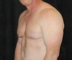 Case--8968 | After Male Breast Reduction 1