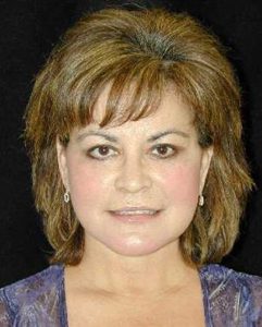 Case--3313 | After Face Lift and Neck Lift 1