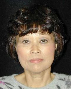 Case--9043 | Before Face Lift and Neck Lift 1