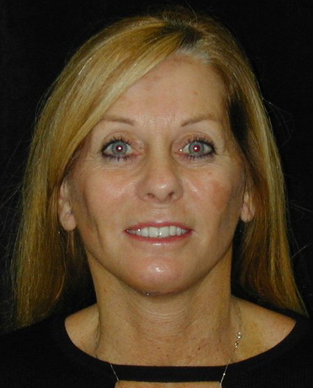 Case--4990 | After Face Lift and Neck Lift 1