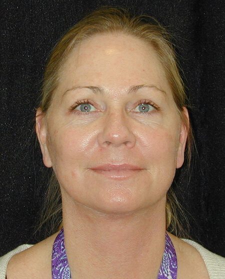 Case--4315 | After Face Lift and Neck Lift 1