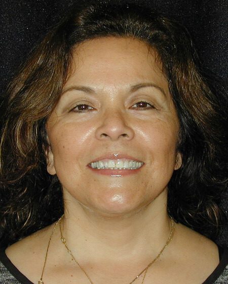 Case--3470 | After Face Lift and Neck Lift 1