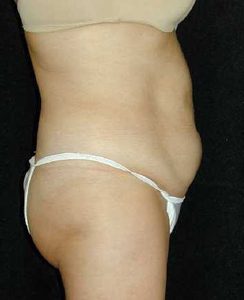 Case--3438 | Before Tummy Tuck 1