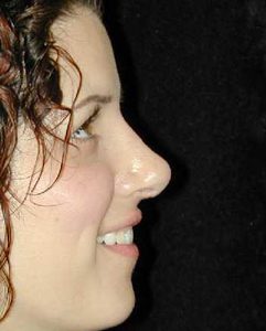 Case--7305 | After Nose Surgery 1