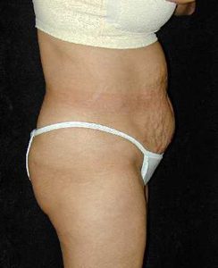 Case--7449 | Before Tummy Tuck 1