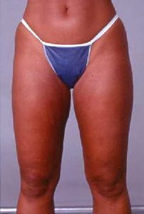 Case--6673 | After Liposuction 1